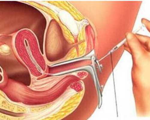 泰国的HIV洗精加三代试管婴儿总费用多少钱？~试管供卵套餐