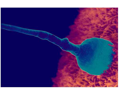 无精子症的原因有哪些 男人没有精子吃什么中药