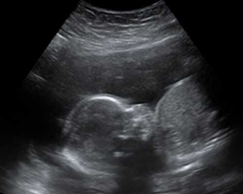 香港验血孕囊积液_香港血液验男女哪_6周和7周有什么区别!