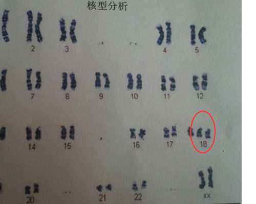 香港验血机构15个p是男孩_香港验血男孩报告单_抽血验孕原理