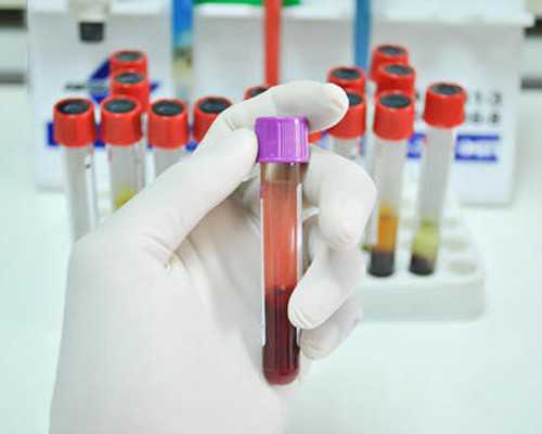 多囊怀孕香港验血,什么导致男性不孕不育造成男性不孕不育的五大主要原因