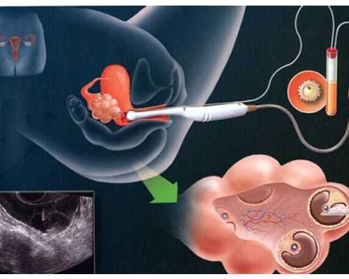 2800元香港验血,子宫肌瘤做试管成功经验总结
